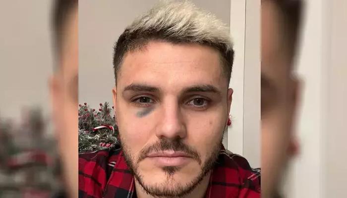 Fenerbahçe maçında darbe almıştı! Galatasaray'dan Mauro Icardi'nin sağlık durumuyla ilgili açıklamaFutbol