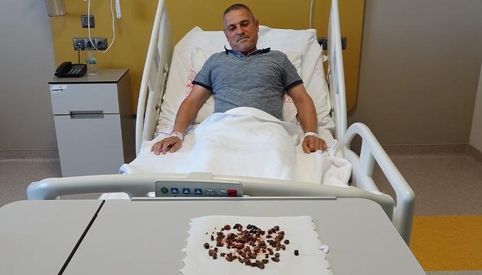 Doktorları şaşkına çeviren vaka: Adamın böbreğinden 100'e yakın taş çıktı: "Sağ böbreğin tamamı taşla doluydu"